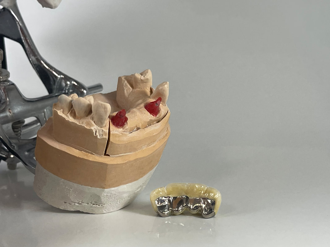 Dental crown restoration detail