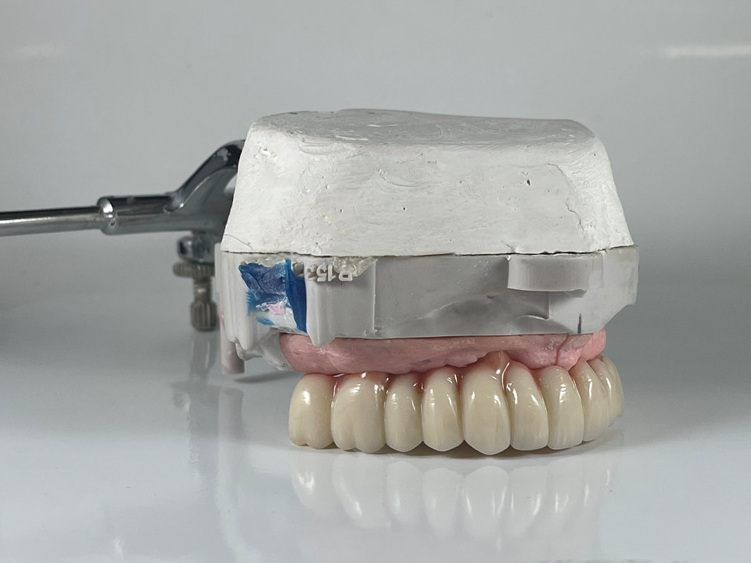 Crown and bridge restoration produced by ANB Dental Lab