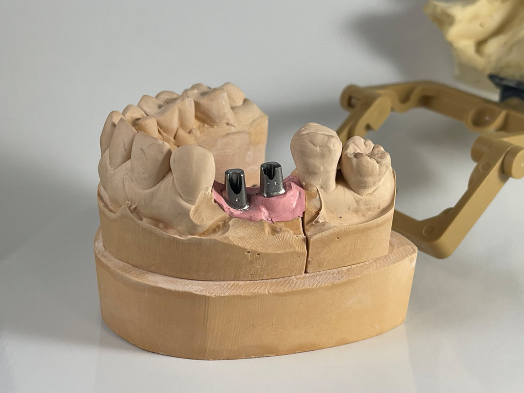 Phục hình implant do ANB Dental Lab chế tác